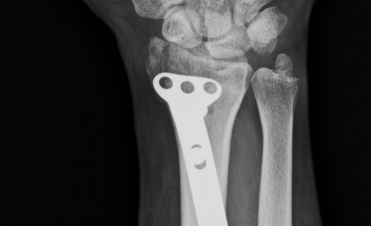 HAROON 31Y0000, successful broken wrist bone surgery