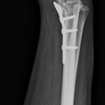 Dr. Kamran Saeed Orthopedic and Trauma Surgeon, Complicated Wrist bone surgery