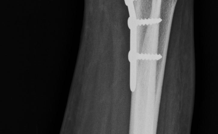 HAROON 31Y0001, broken wrist bone surgery