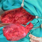 Dr. Kamran Saeed Orthopedic Surgeon, Skeletal Tumor Removal Surgery