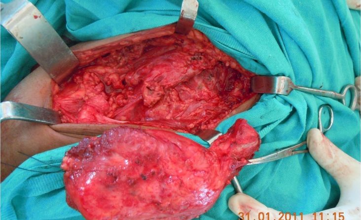Dr. Kamran Saeed Orthopedic Surgeon, Skeletal Tumor Removal Surgery